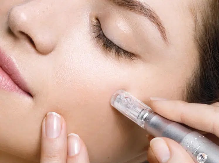 Microneedling treatment