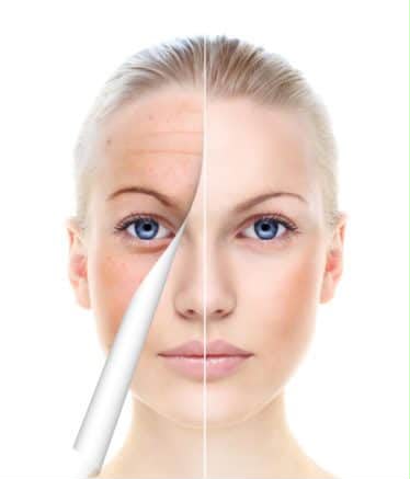 Profhilo skin treatment at Clinic 8, West Malling